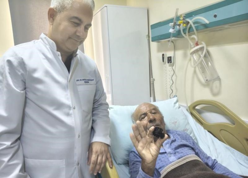 BOZYAZI’DA 4 SANTİMETRELİK MESANE TAŞI TEK PARÇA HALİNDE ÇIKARILDI.